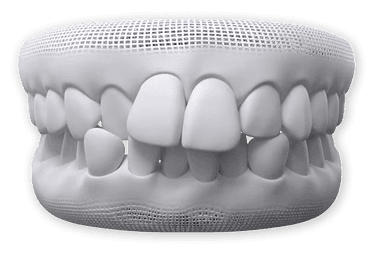 Crowded Teeth