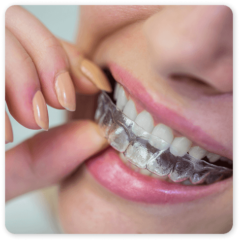 Patient placing clear aligners on teeth